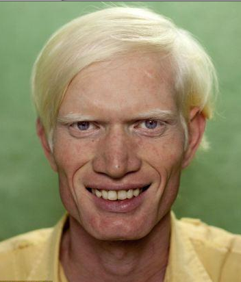 Image result for black albinos